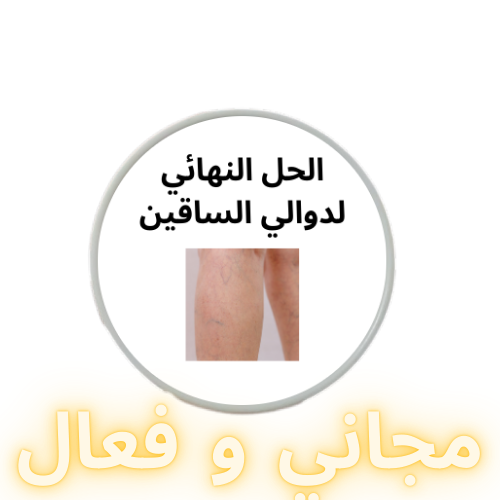 كريمة لعلاج دوالي الساقين نهائيا